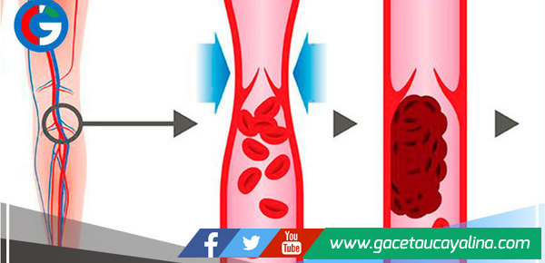 Pasar altas horas viendo series aumenta el riesgo de padecer Trombosis