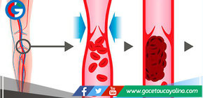 Pasar altas horas viendo series aumenta el riesgo de padecer Trombosis