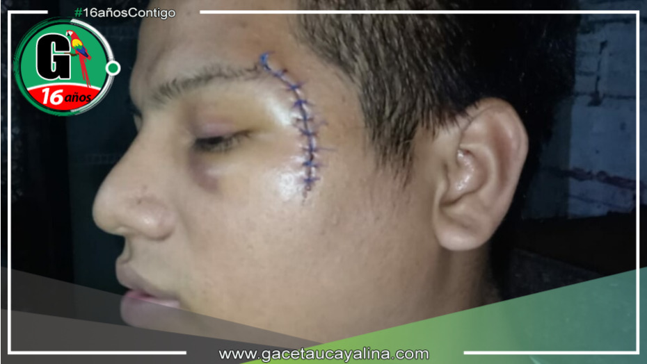 Joven de 22 años queda con el rostro desfigurado tras ser atacado con una botella en Loreto