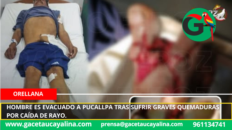 Hombre es evacuado a Pucallpa tras sufrir graves quemaduras por caída de rayo.