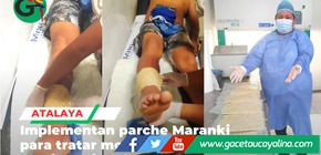 Hospital de Atalaya implementa parche ancestral contra mordedura de jergón